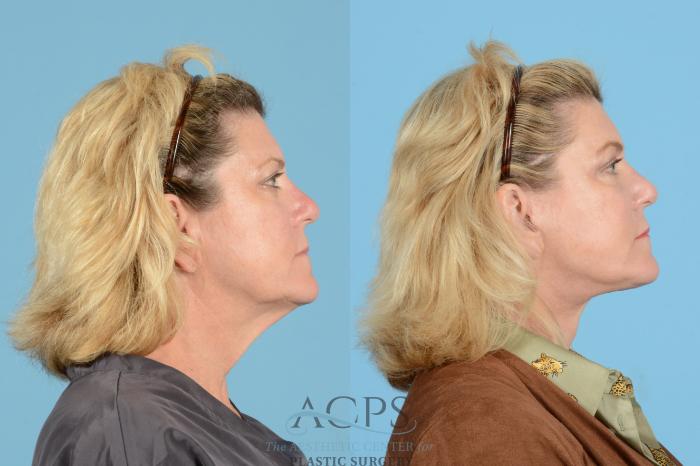 Before & After Brow Lift Case 1539 Right Side View in Houston, TX