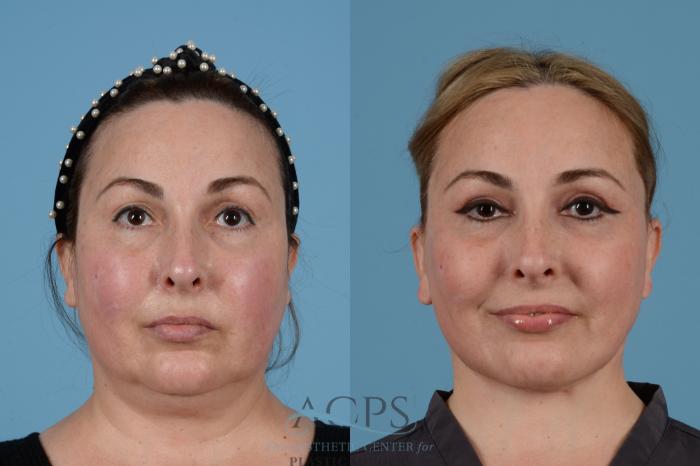 Before & After Facelift Case 1540 Front View in Houston, TX