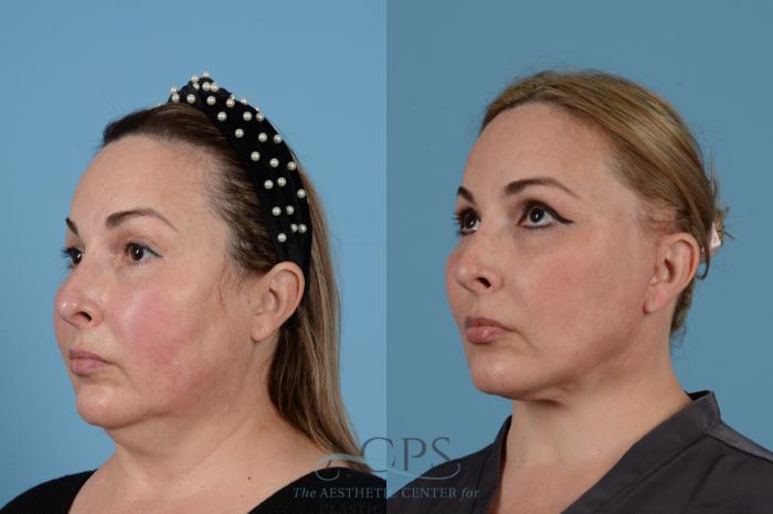 Before & After Facelift Case 1540 Left Oblique View in Houston, TX