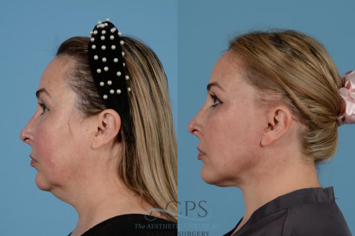 Before & After Facelift Case 1540 Left Side View in Houston, TX