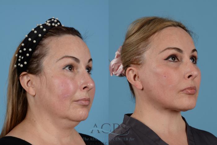 Before & After Facelift Case 1540 Right Oblique View in Houston, TX