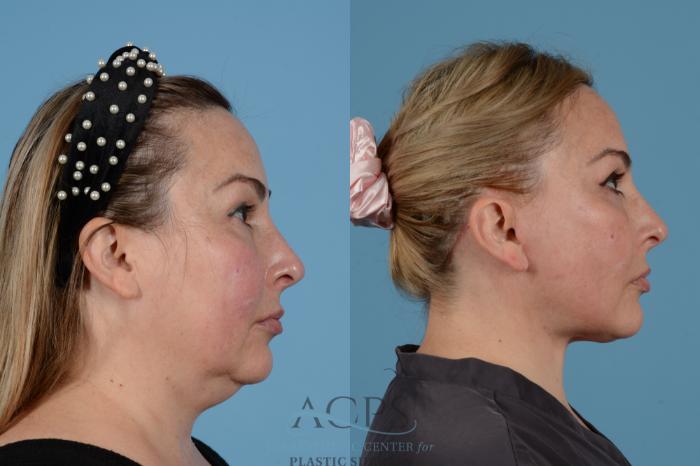 Before & After Facelift Case 1540 Right Side View in Houston, TX