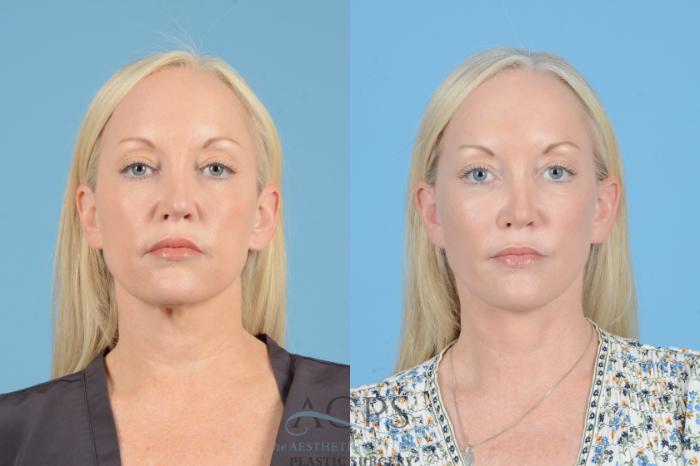 Before & After Facelift Case 1545 Front View in Houston, TX