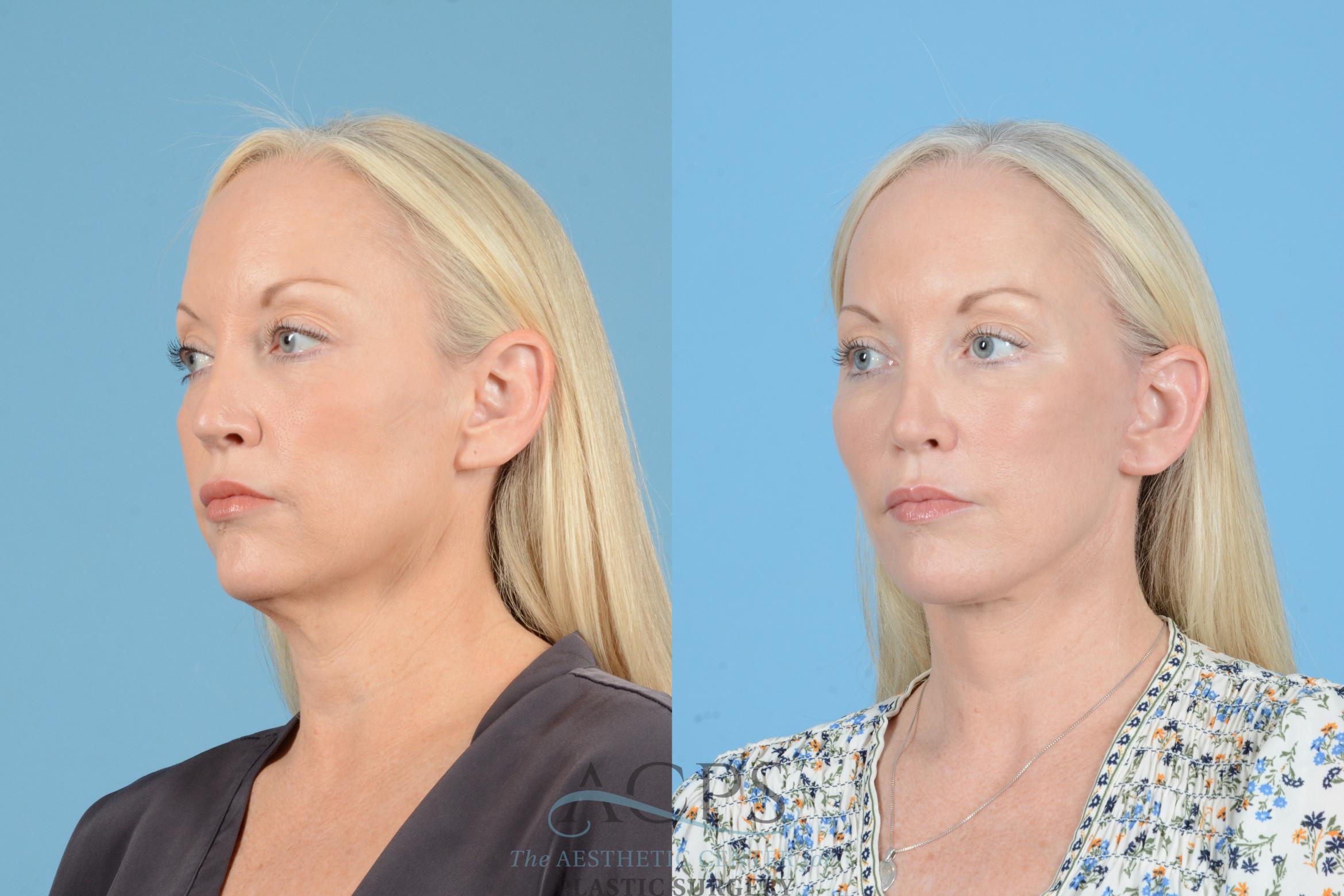 Before & After Facelift Case 1545 Left Oblique View in Houston, TX