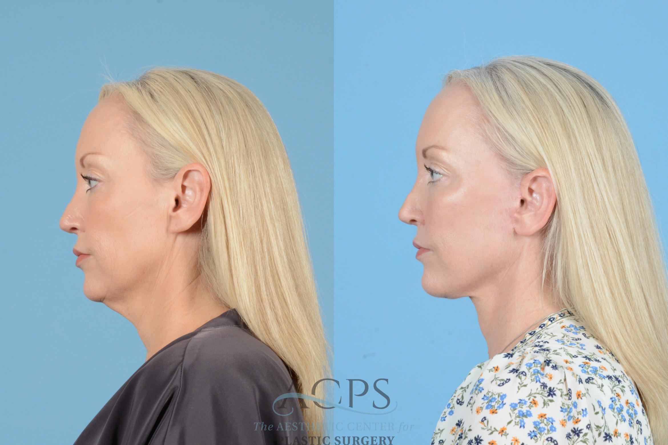 Before & After Facelift Case 1545 Left Side View in Houston, TX