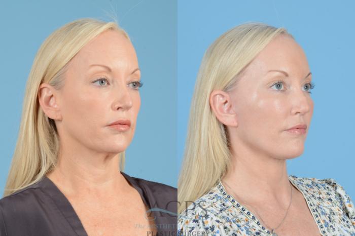 Before & After Facelift Case 1545 Right Oblique View in Houston, TX