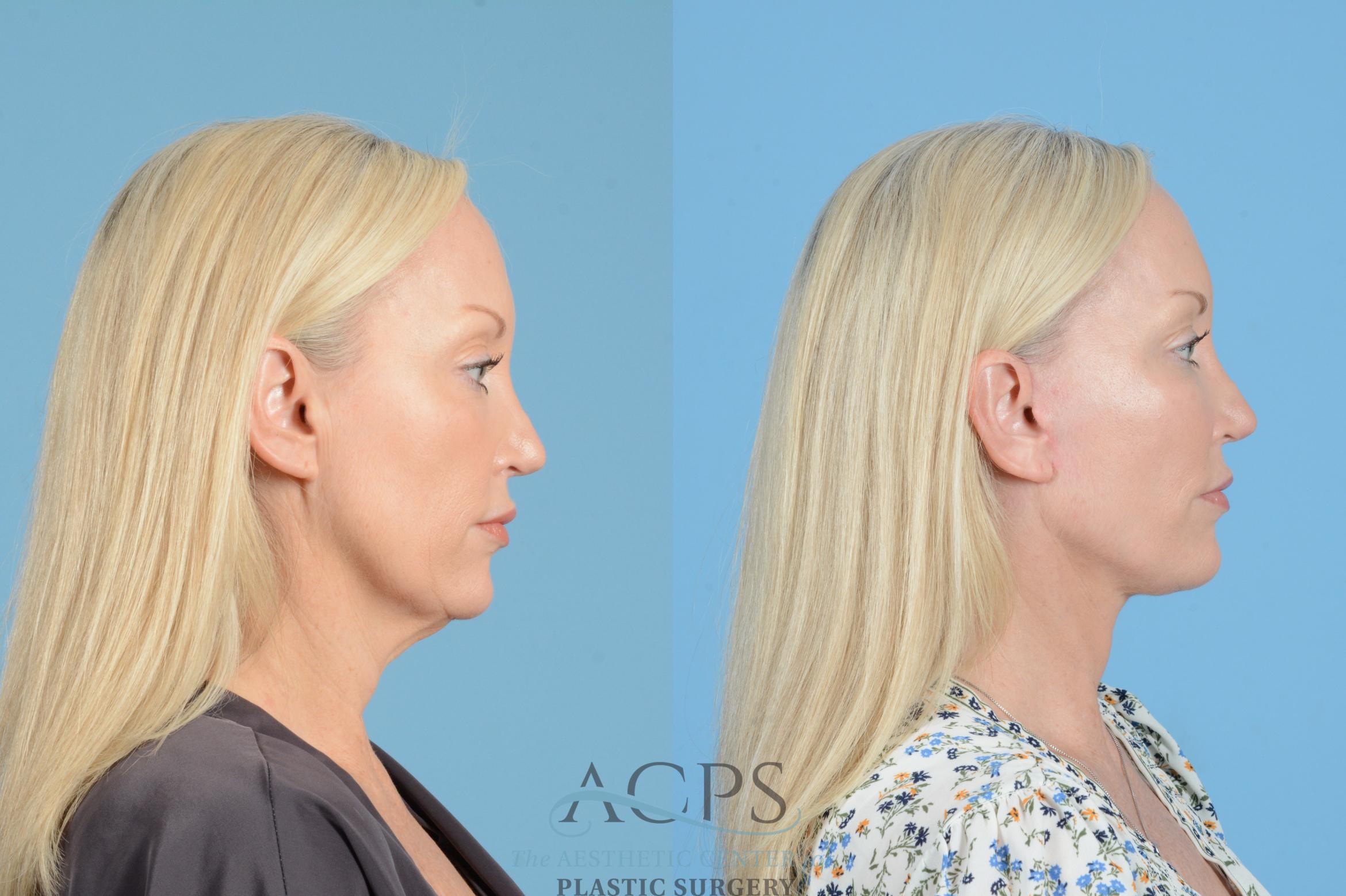 Before & After Facelift Case 1545 Right Side View in Houston, TX