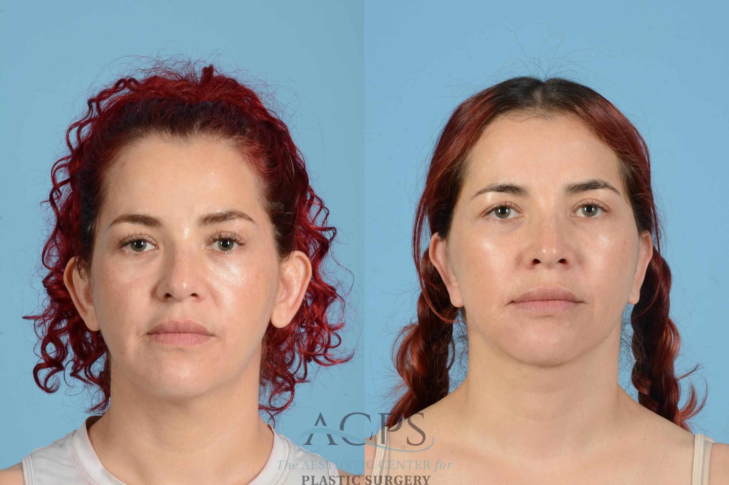 Before & After Neck Lift Case 1555 Front View in Houston, TX