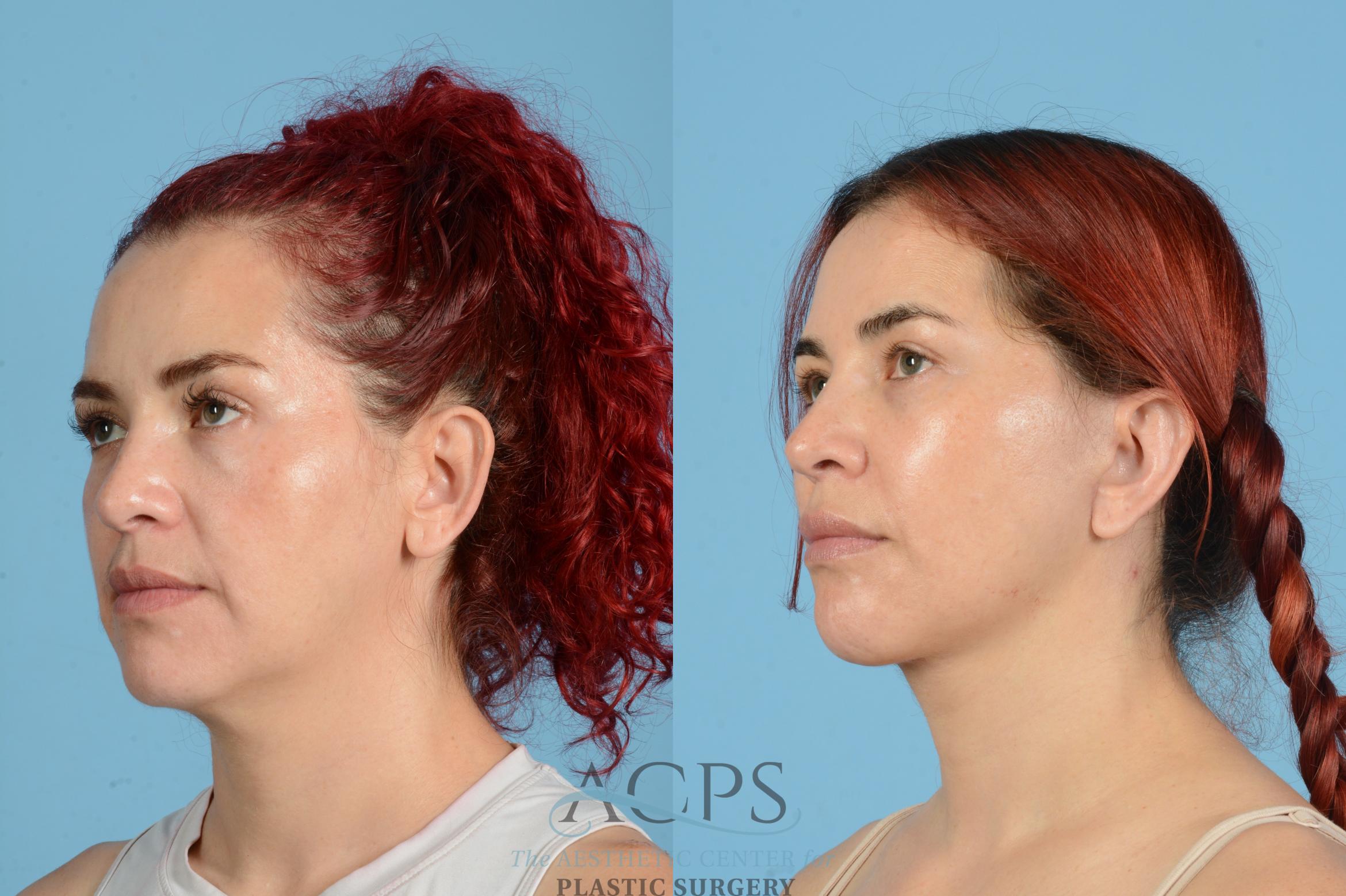 Before & After Neck Lift Case 1555 Left Oblique View in Houston, TX