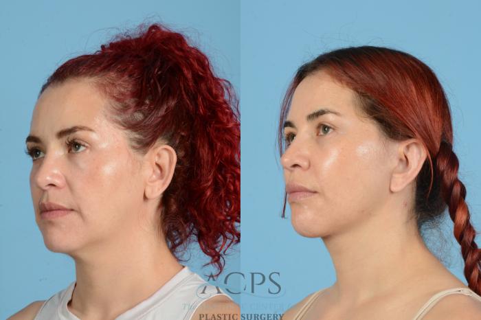 Before & After Neck Lift Case 1555 Left Oblique View in Houston, TX