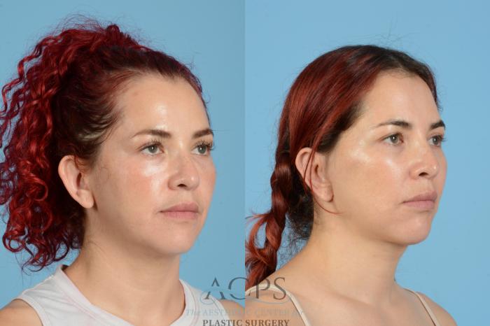 Before & After Neck Lift Case 1555 Right Oblique View in Houston, TX