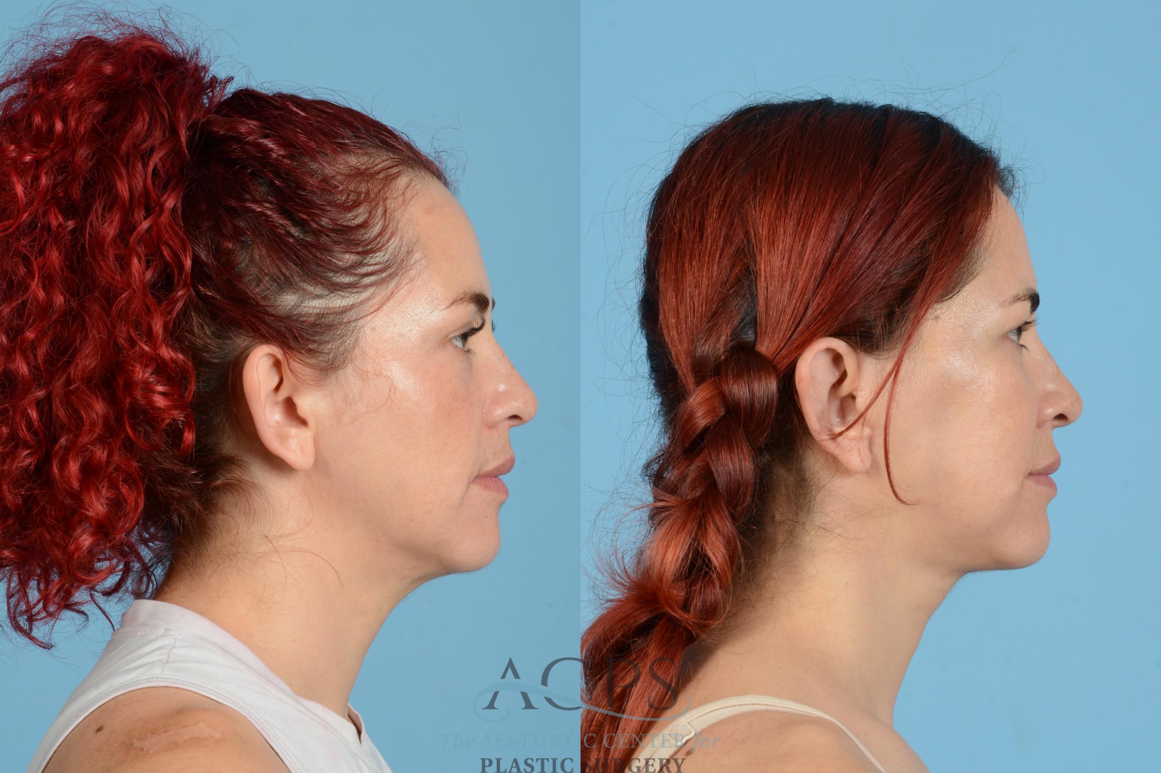 Before & After Neck Lift Case 1555 Right Side View in Houston, TX