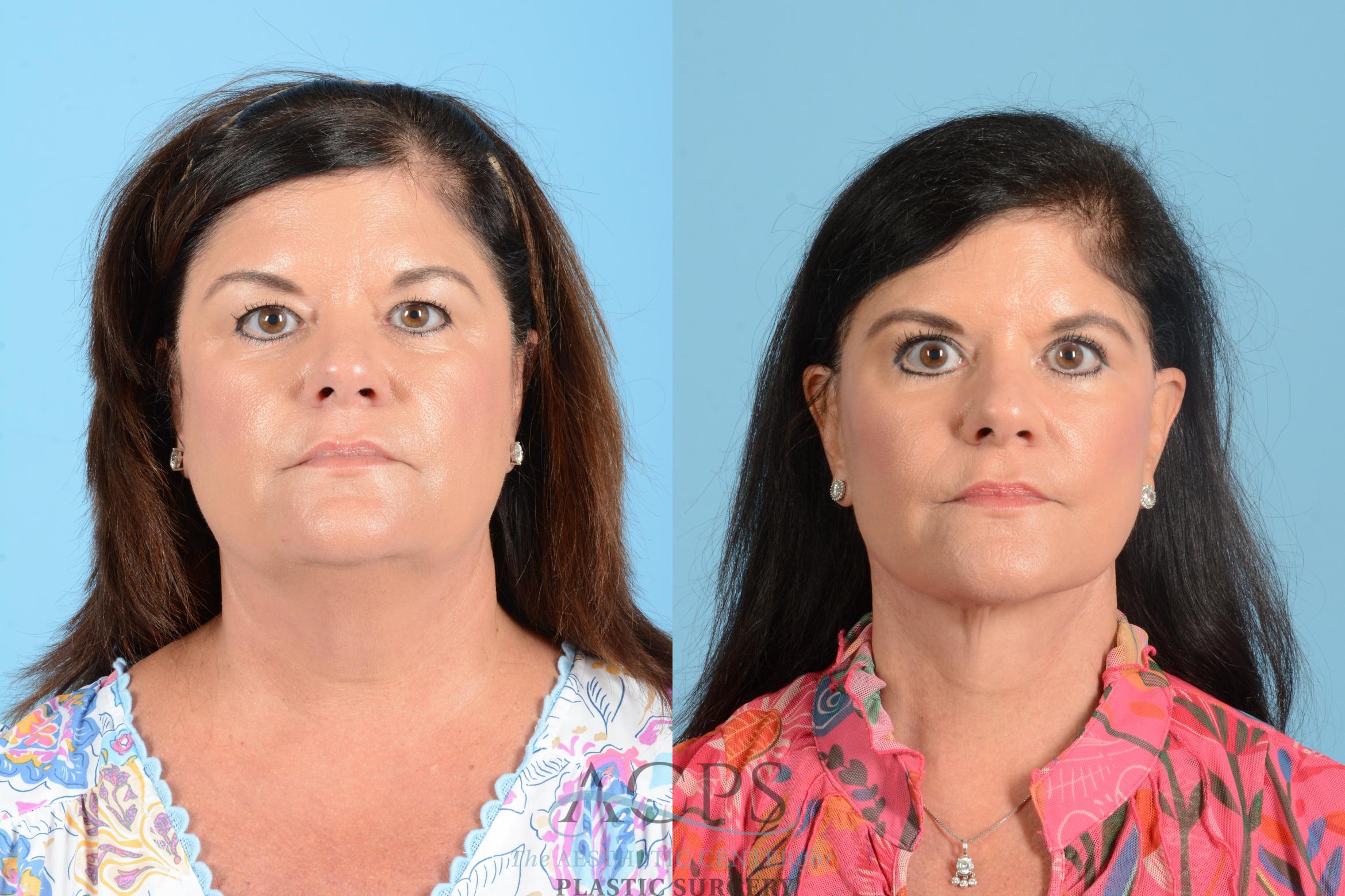 Before & After Facelift Case 1556 Front View in Houston, TX