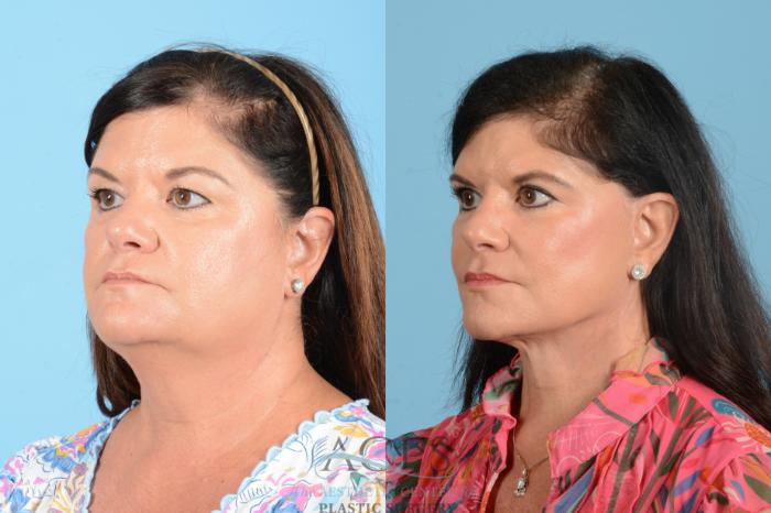 Before & After Facelift Case 1556 Left Oblique View in Houston, TX