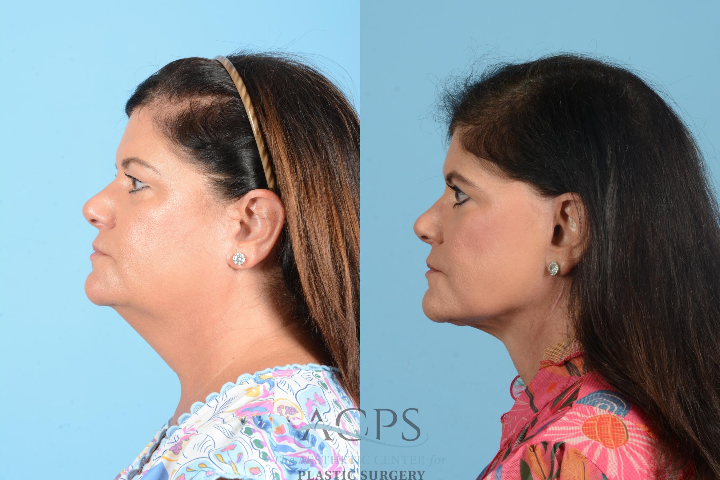 Before & After Facelift Case 1556 Left Side View in Houston, TX