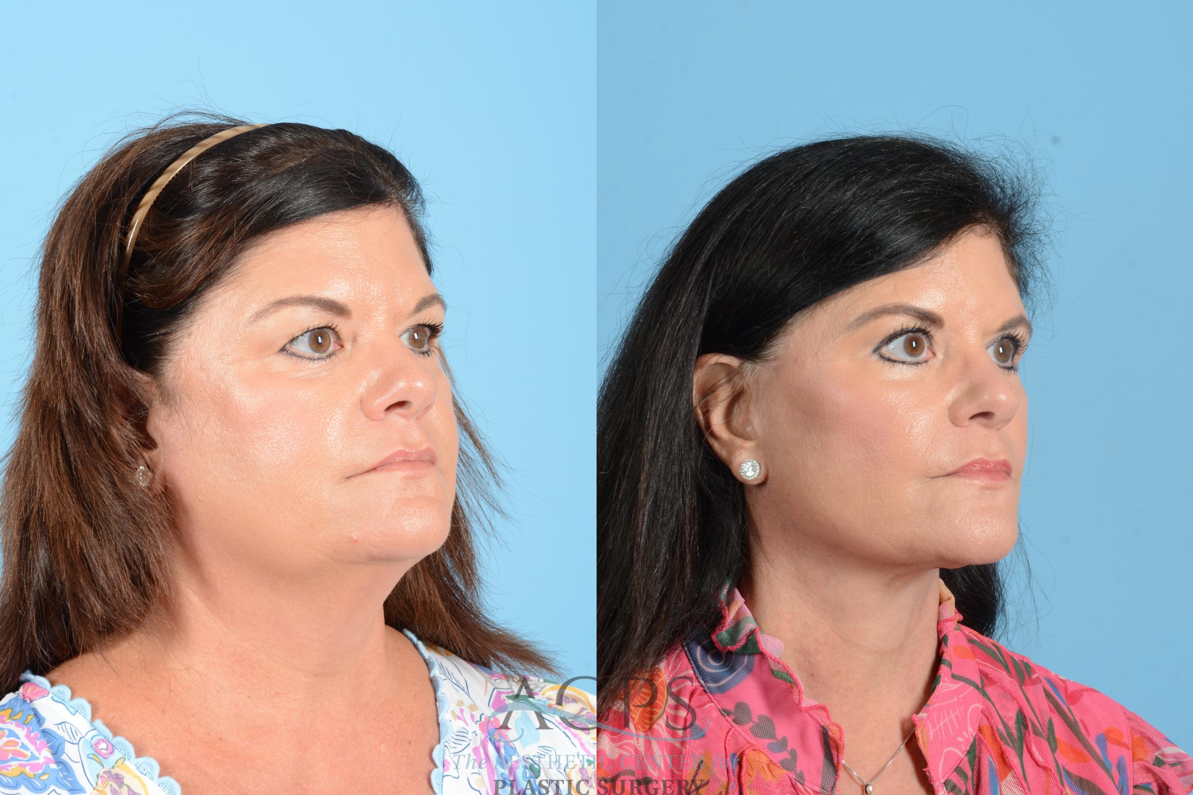 Before & After Facelift Case 1556 Right Oblique View in Houston, TX