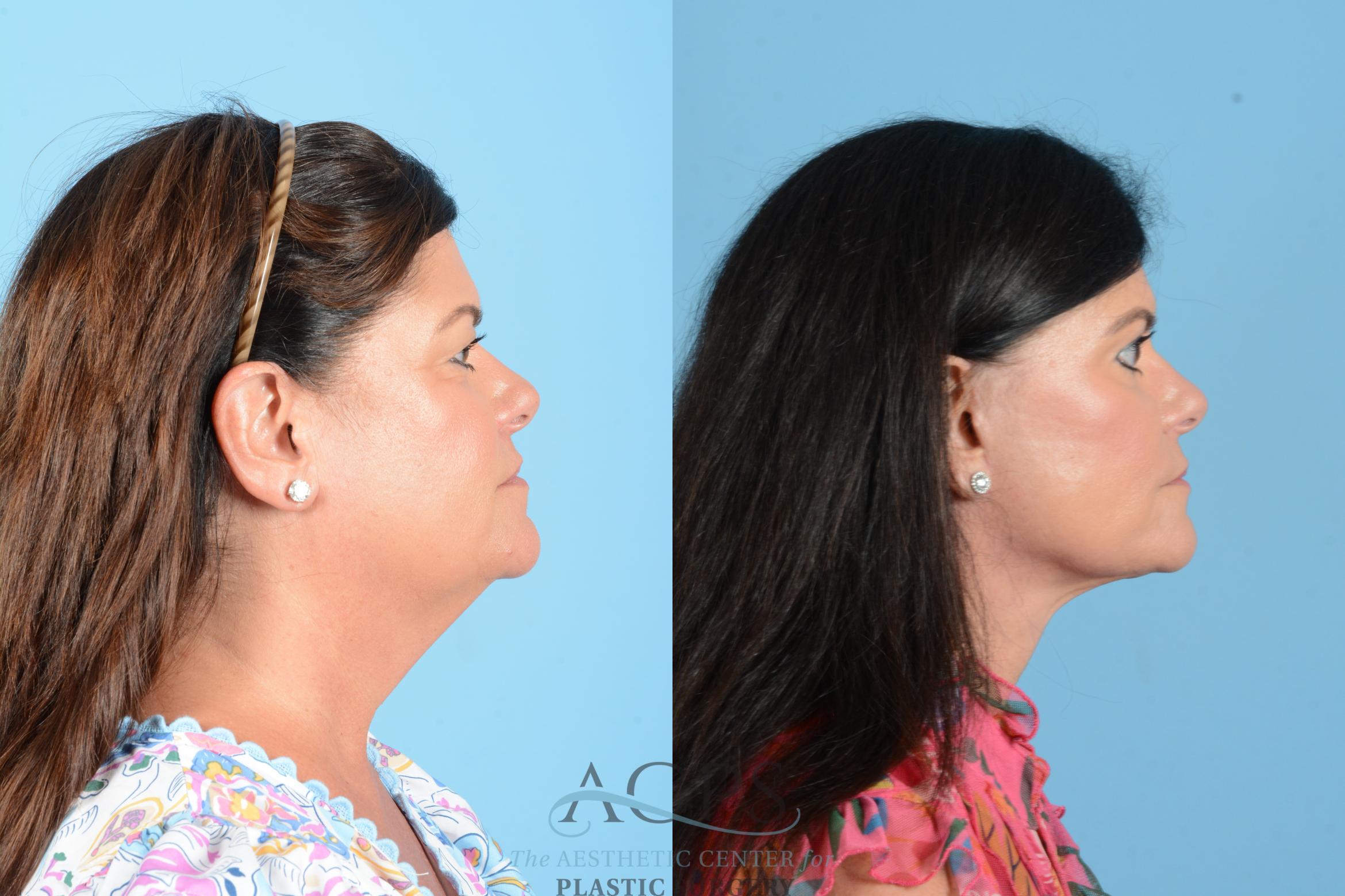 Before & After Facelift Case 1556 Right Side View in Houston, TX