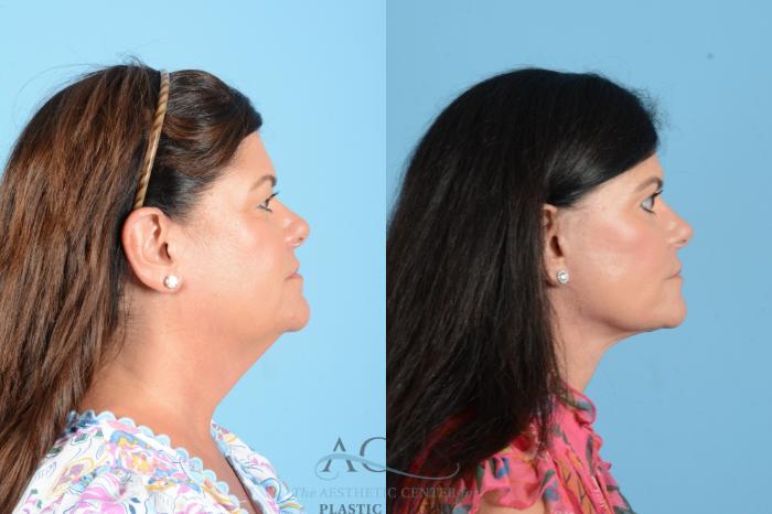 Before & After Facelift Case 1556 Right Side View in Houston, TX