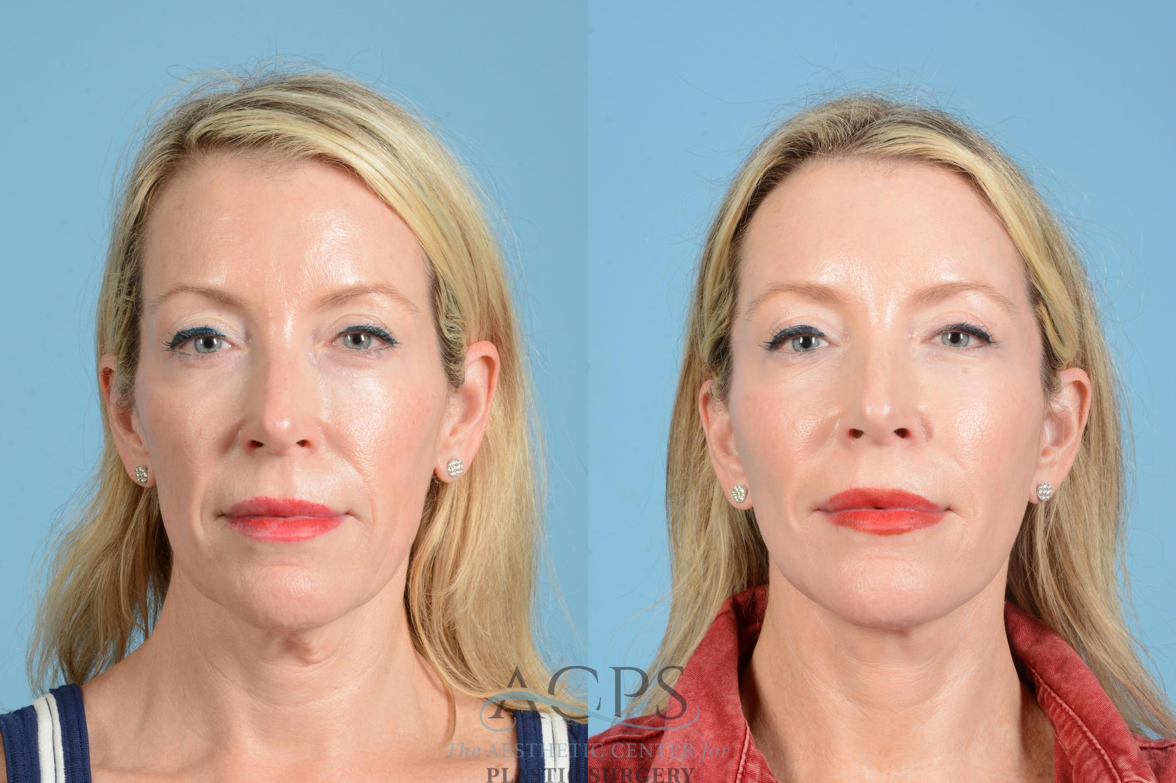 Before & After Facelift Case 1557 Front View in Houston, TX