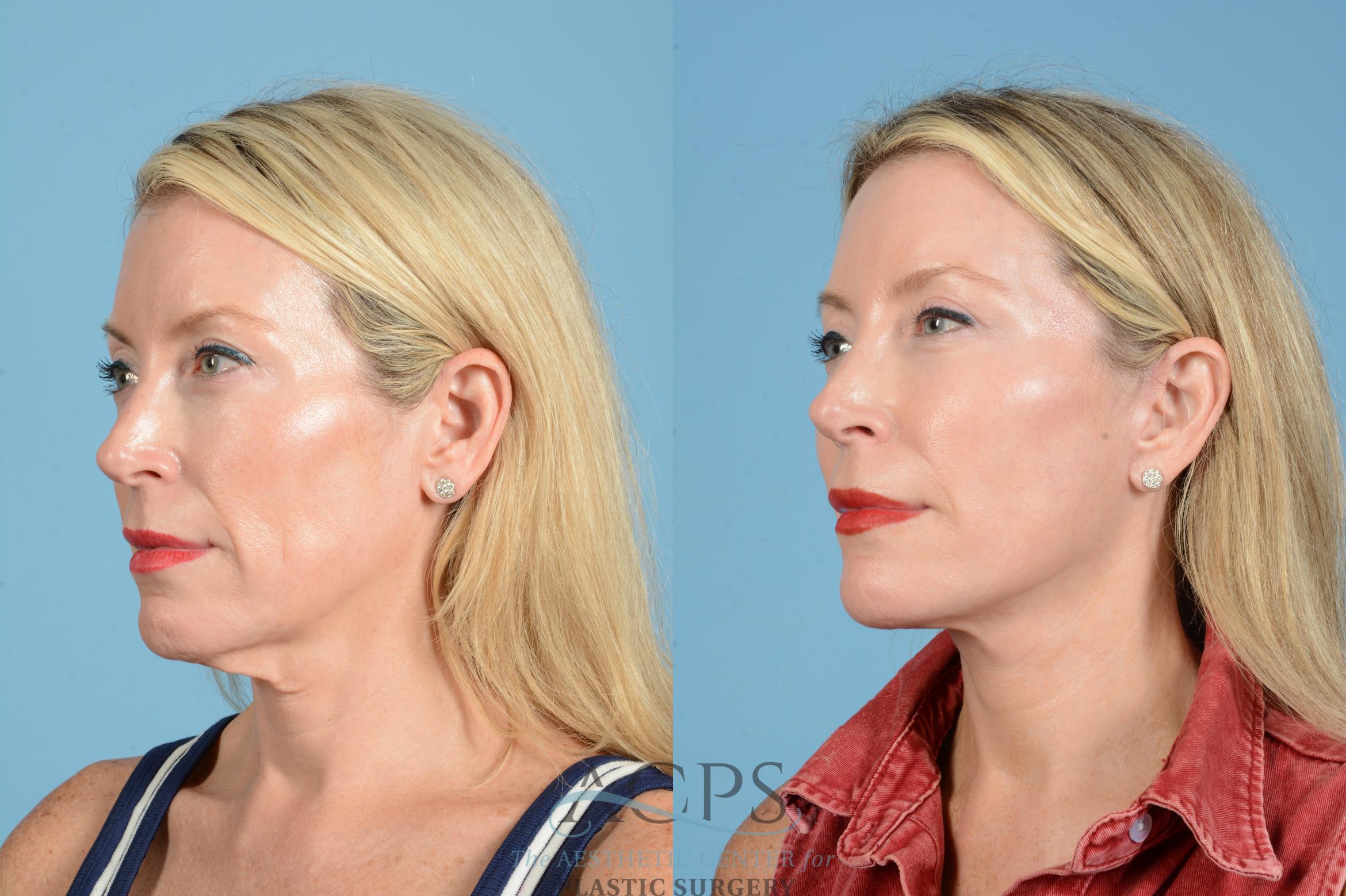 Before & After Facelift Case 1557 Left Oblique View in Houston, TX