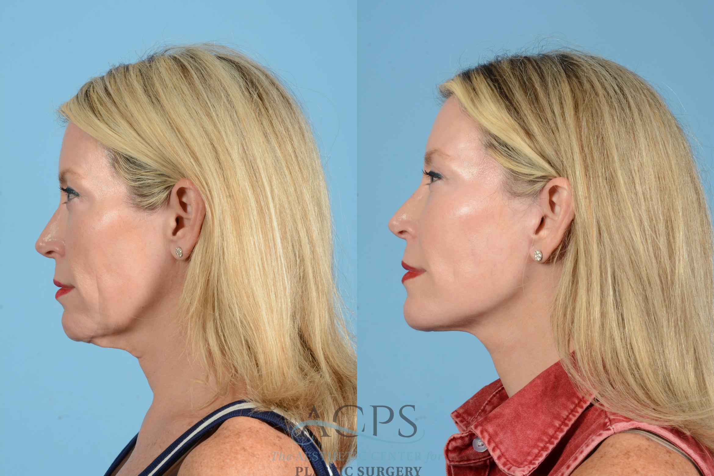 Before & After Facelift Case 1557 Left Side View in Houston, TX