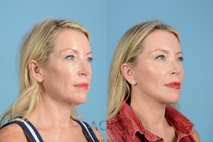 Before & After Facelift Case 1557 Right Oblique View in Houston, TX