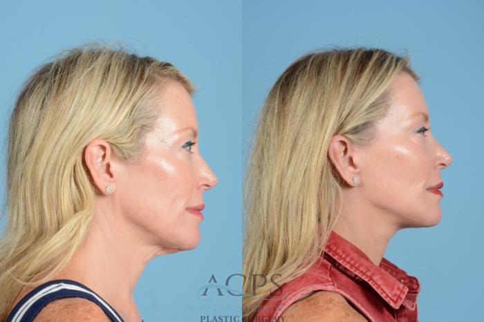 Before & After Facelift Case 1557 Right Side View in Houston, TX