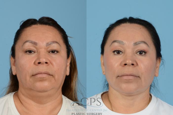Before & After Facelift Case 1563 Front View in Houston, TX