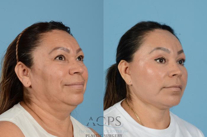Before & After Facelift Case 1563 Left Oblique View in Houston, TX