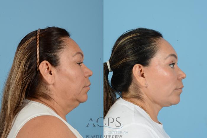 Before & After Facelift Case 1563 Left Side View in Houston, TX