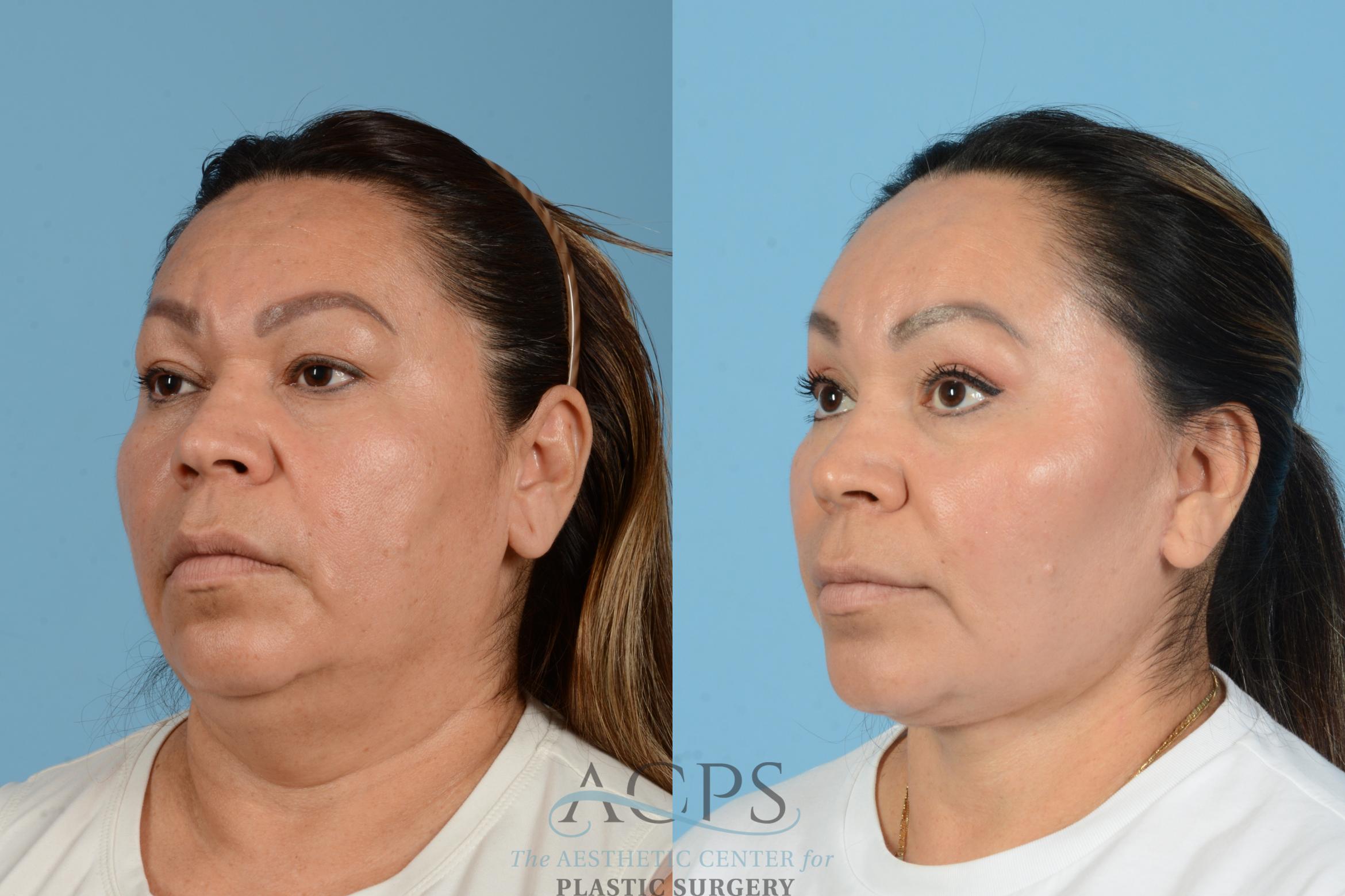 Before & After Facelift Case 1563 Right Oblique View in Houston, TX