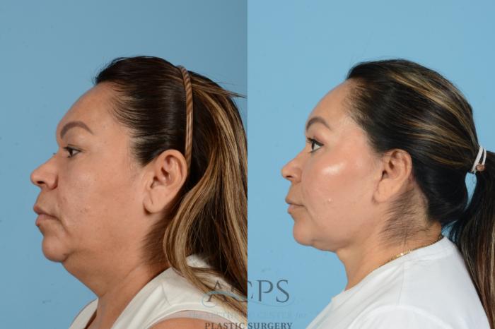 Before & After Facelift Case 1563 Right Side View in Houston, TX