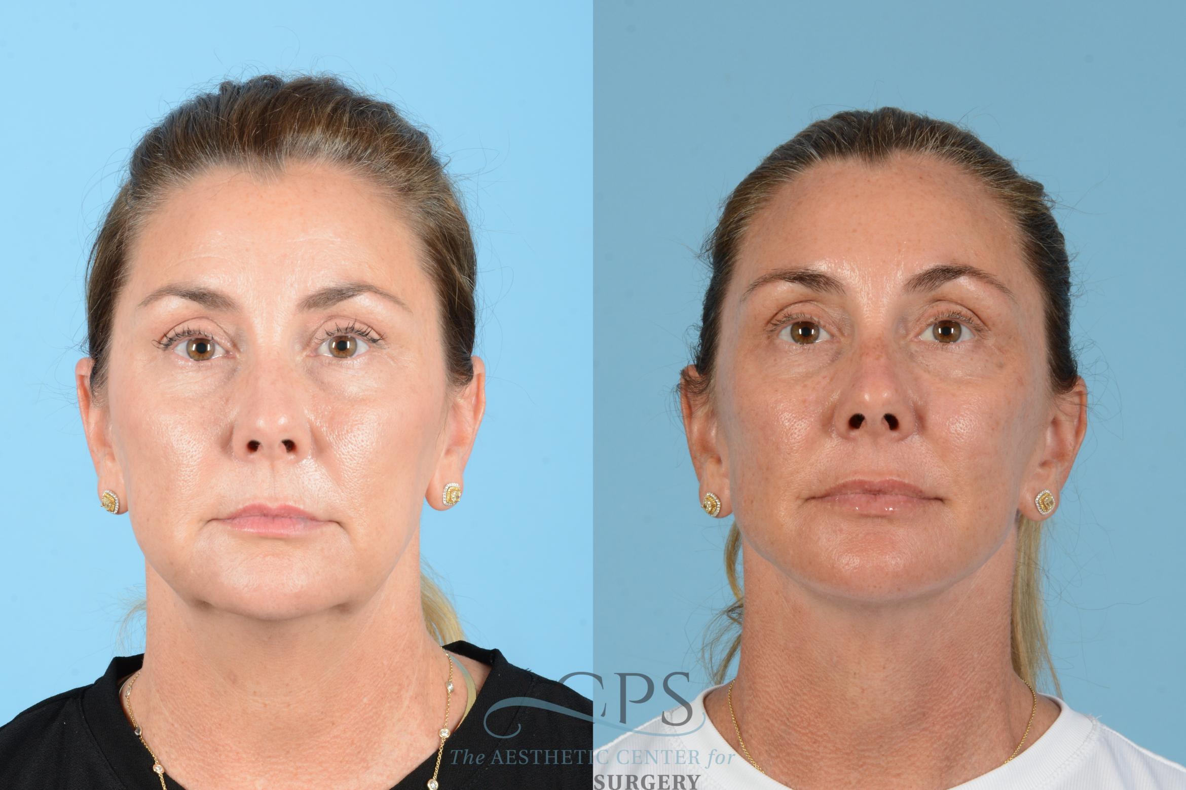 Before & After Facelift Case 1566 Front View in Houston, TX
