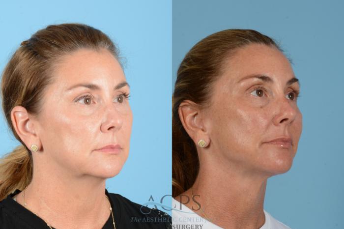 Before & After Facelift Case 1566 Left Oblique View in Houston, TX