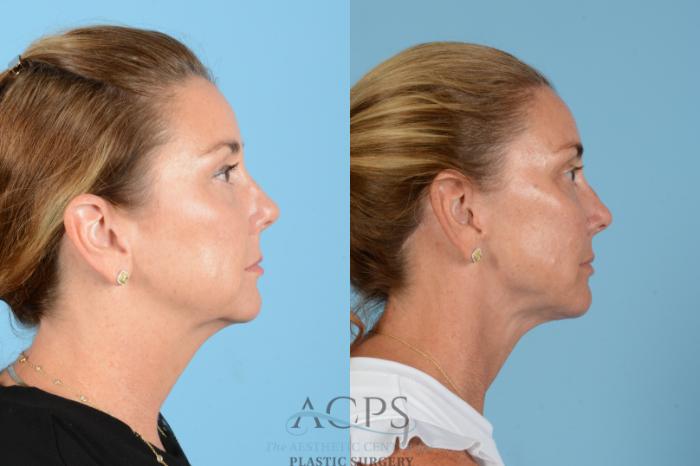 Before & After Facelift Case 1566 Left Side View in Houston, TX