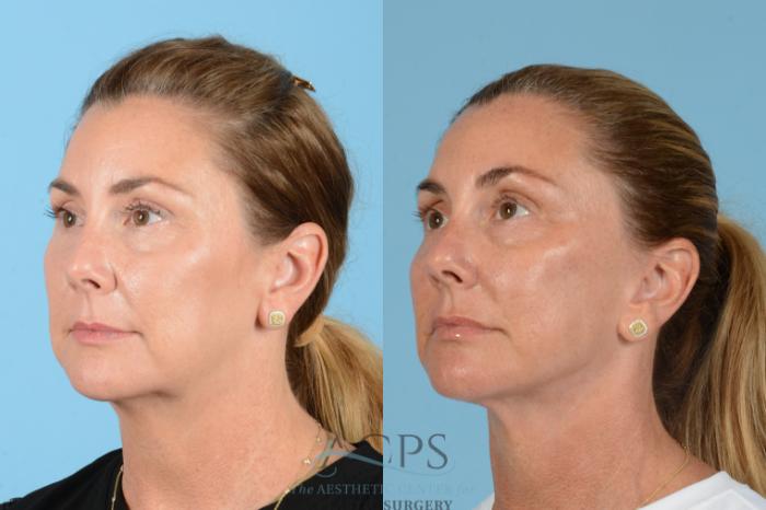 Before & After Facelift Case 1566 Right Oblique View in Houston, TX