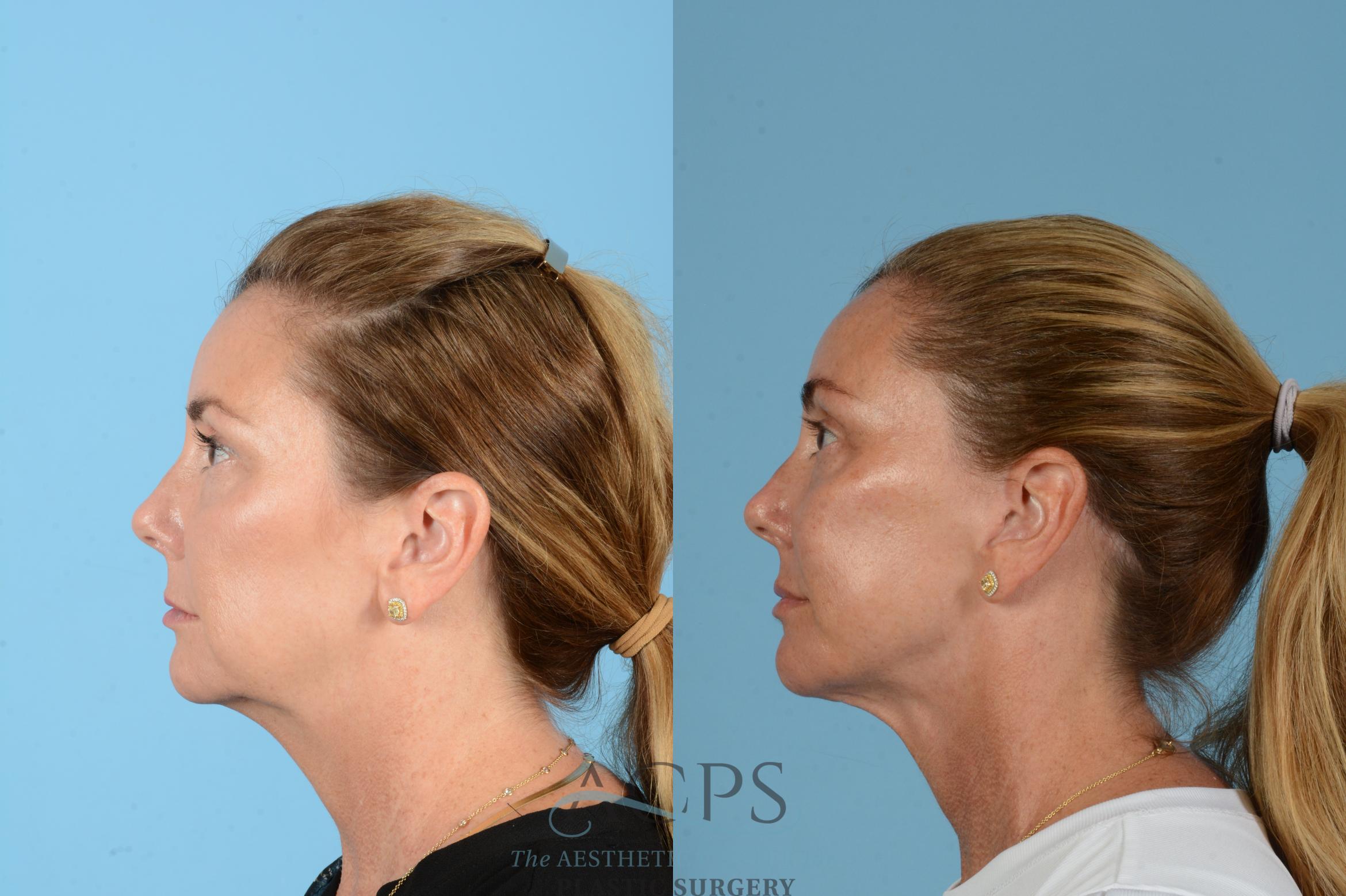 Before & After Facelift Case 1566 Right Side View in Houston, TX