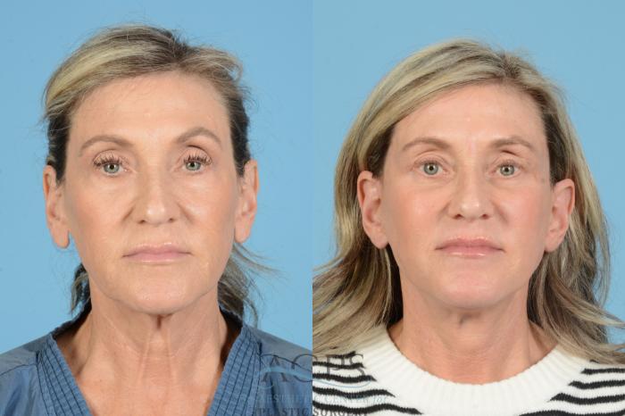 Before & After Fat Grafting Case 1567 Front View in Houston, TX