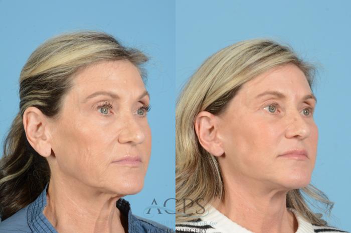 Before & After Fat Grafting Case 1567 Left Oblique View in Houston, TX