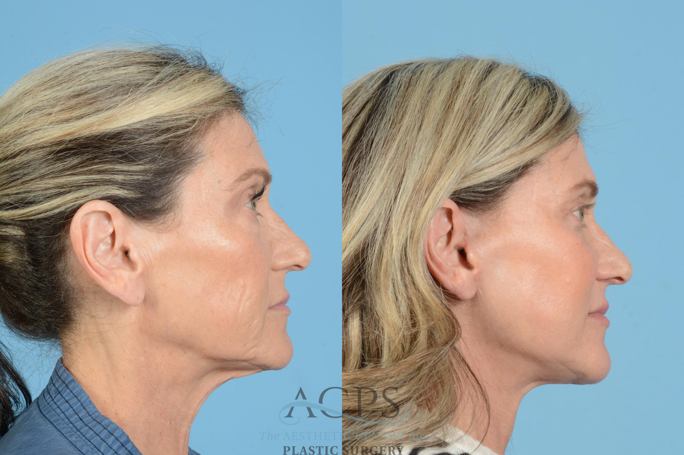 Before & After Fat Grafting Case 1567 Left Side View in Houston, TX