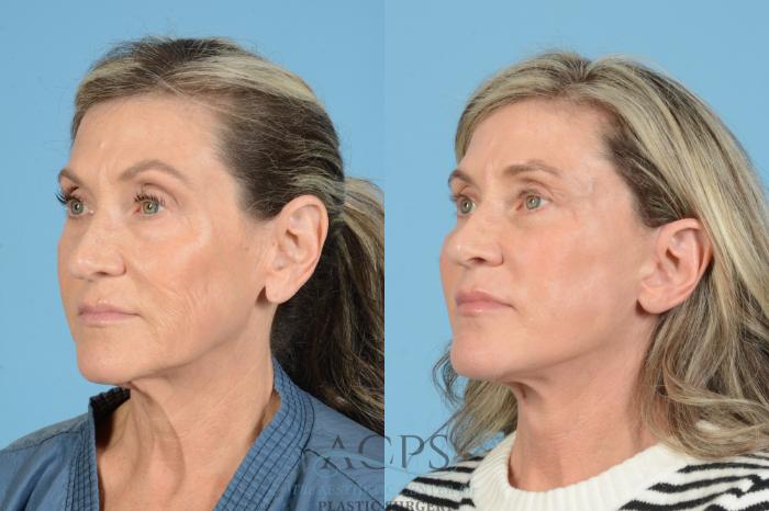 Before & After Fat Grafting Case 1567 Right Oblique View in Houston, TX