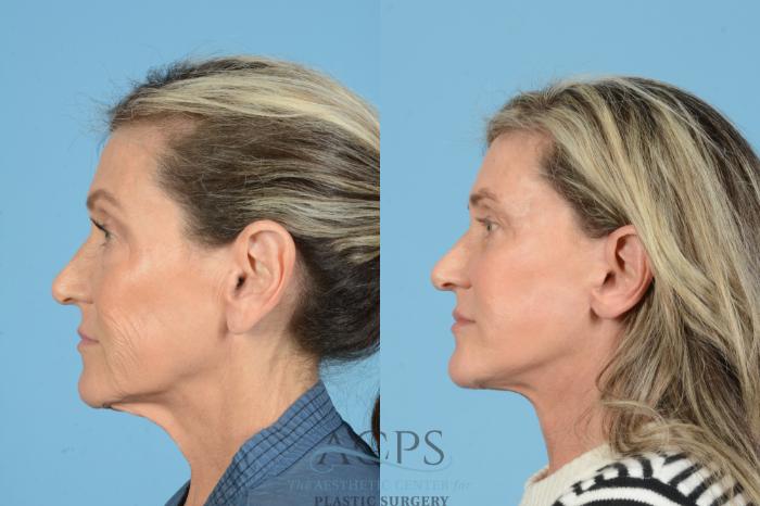 Before & After Fat Grafting Case 1567 Right Side View in Houston, TX