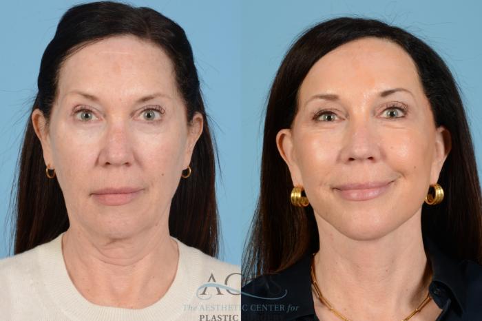 Before & After Facelift Case 1569 Front View in Houston, TX