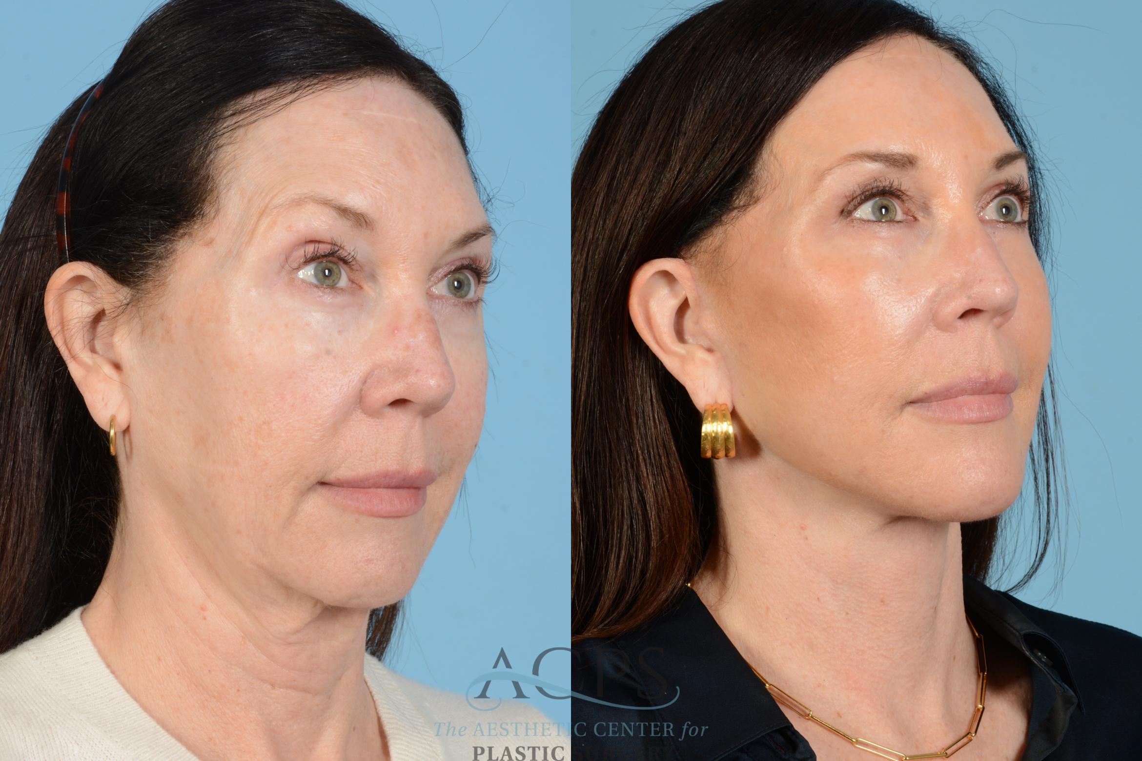 Before & After Facelift Case 1569 Left Oblique View in Houston, TX