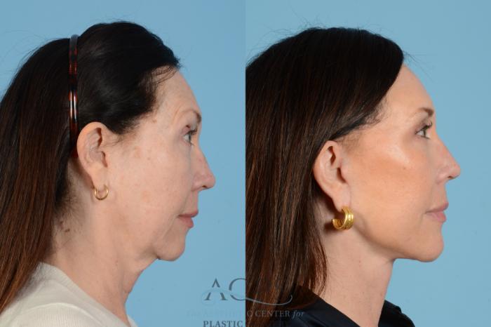 Before & After Facelift Case 1569 Left Side View in Houston, TX