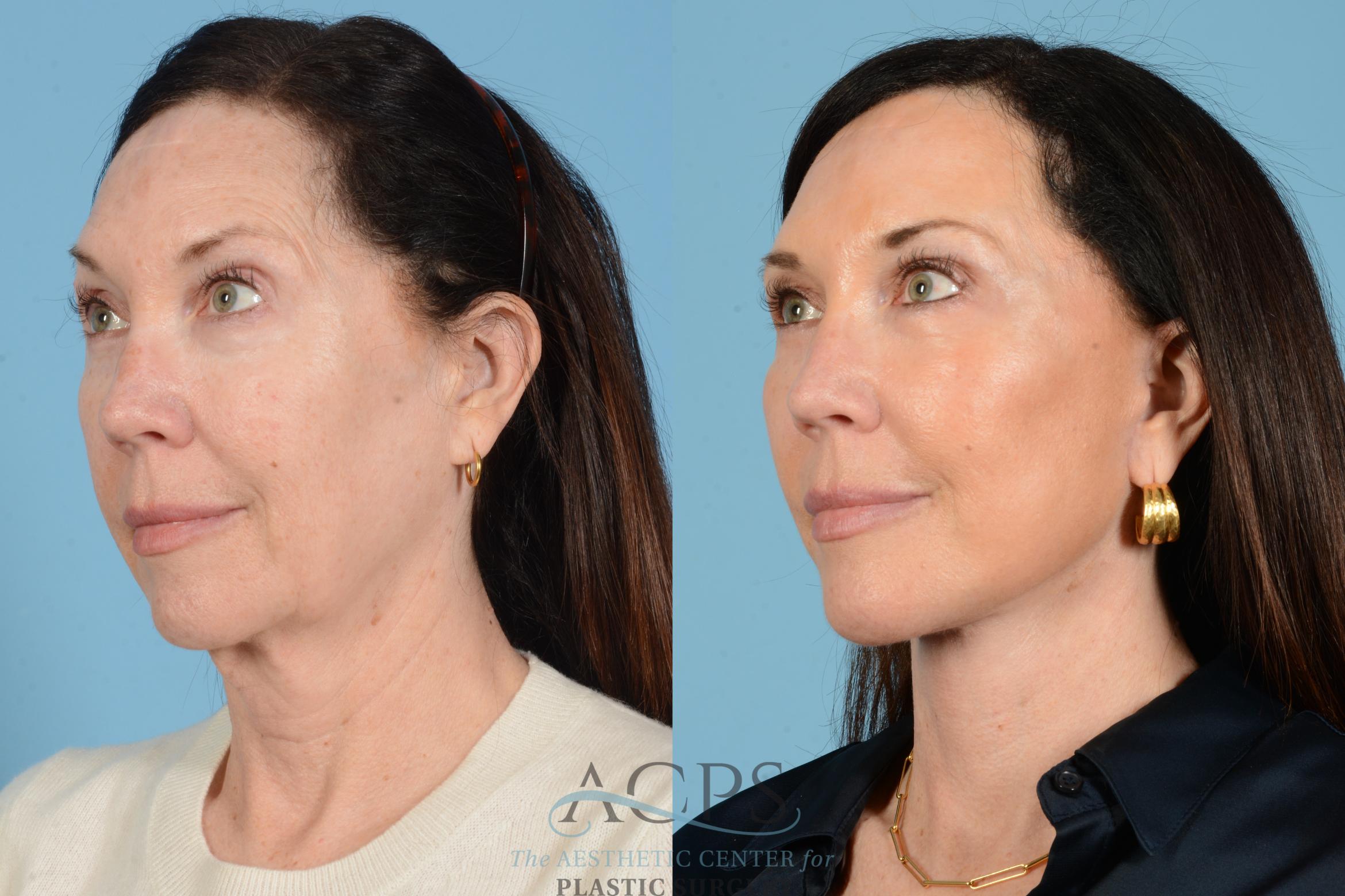 Before & After Facelift Case 1569 Right Oblique View in Houston, TX