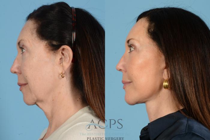 Before & After Facelift Case 1569 Right Side View in Houston, TX