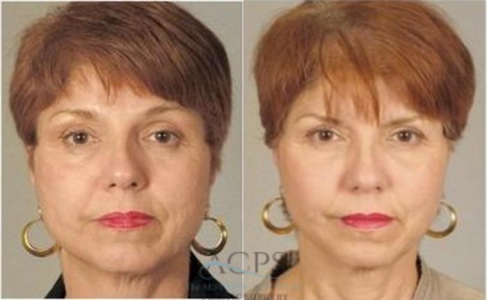 Before & After Fat Grafting Case 1348 Front View: View in Houston, TX