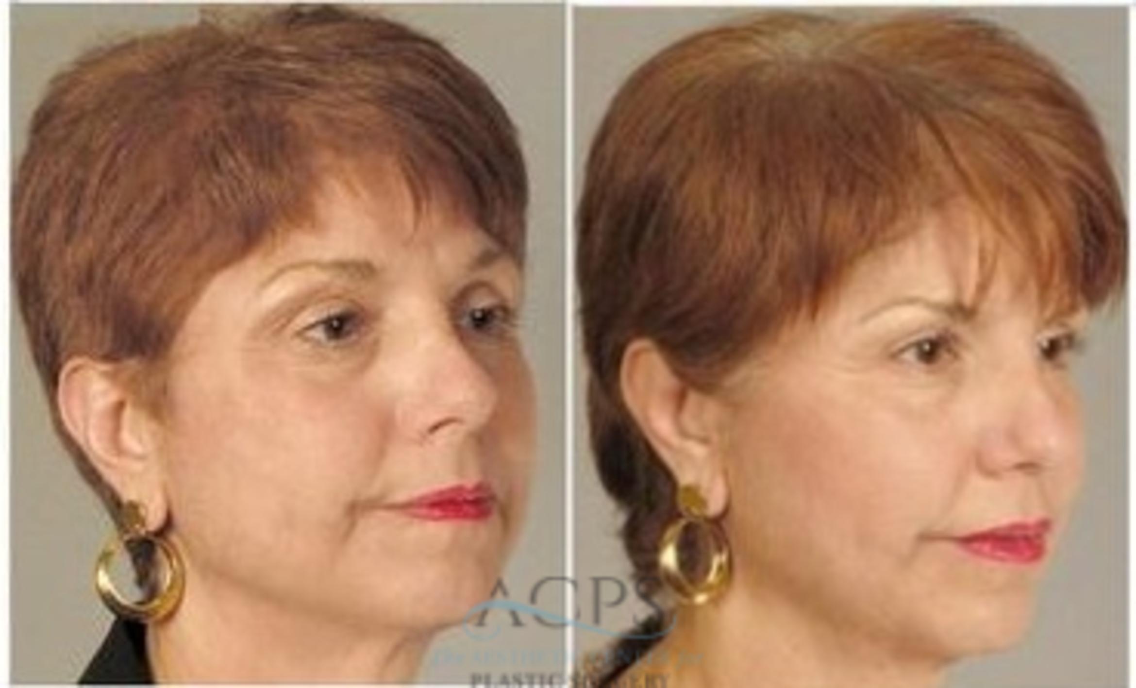Before & After Fat Grafting Case 1348 Oblique View: View in Houston, TX