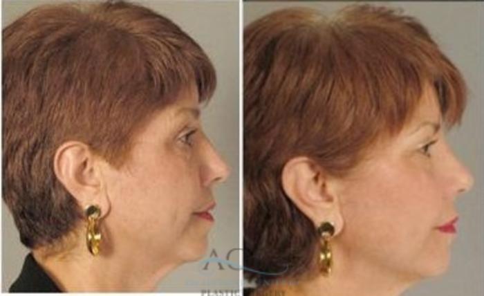 Before & After Fat Grafting Case 1348 Side View: View in Houston, TX